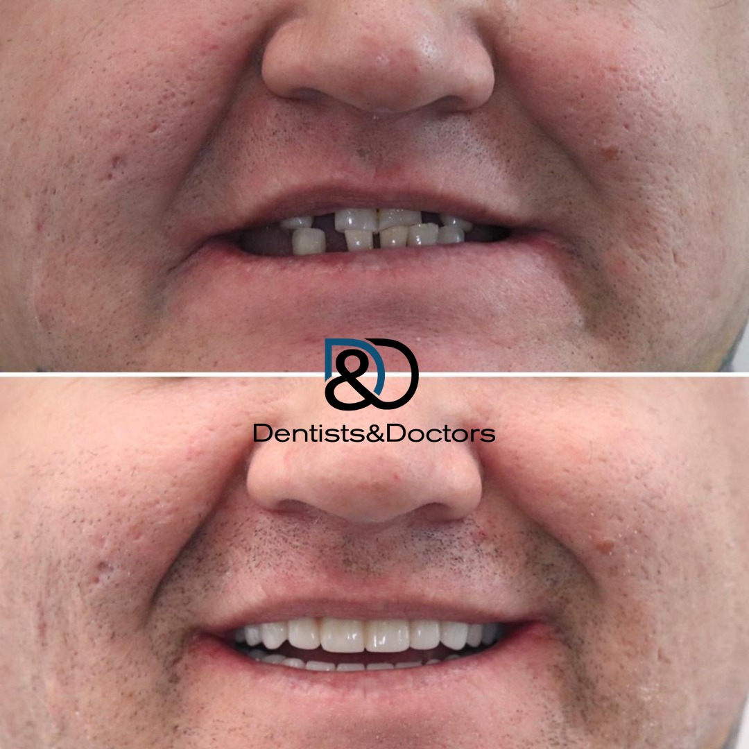 Full Mouth Rehabilitation In Geelong With Dentists & Doctors
